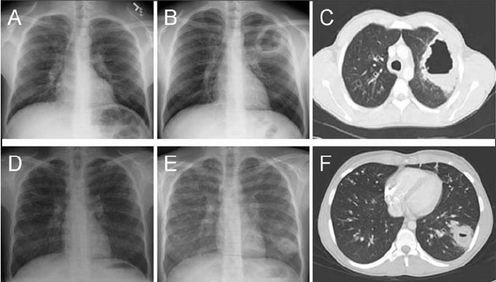Radiographic-evidence-of-lung-abscess-secondary-to-PVL-MRSA-in-two-adolescent-CF